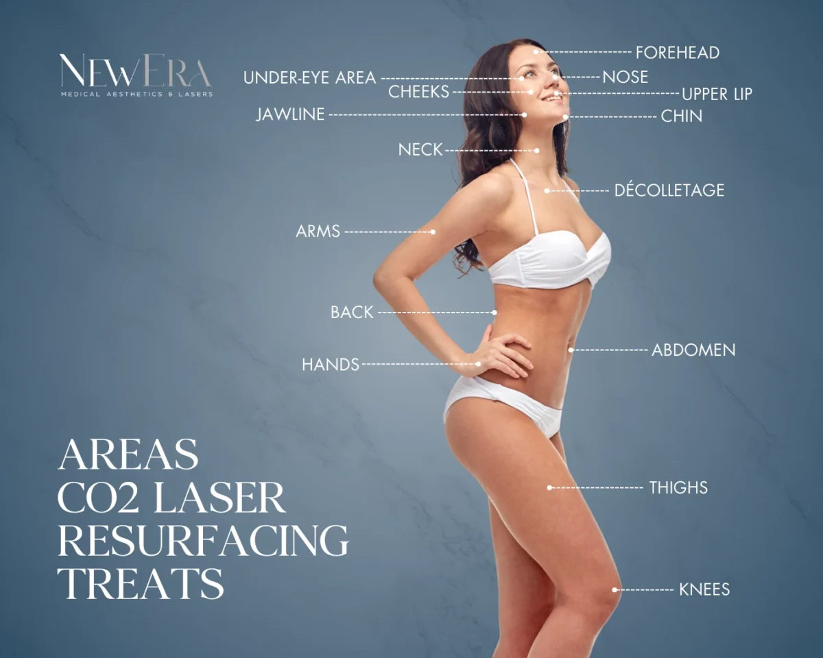 Diagram of facial areas CO2 laser resurfacing treats at NewEra Medical Aesthetics, Vienna